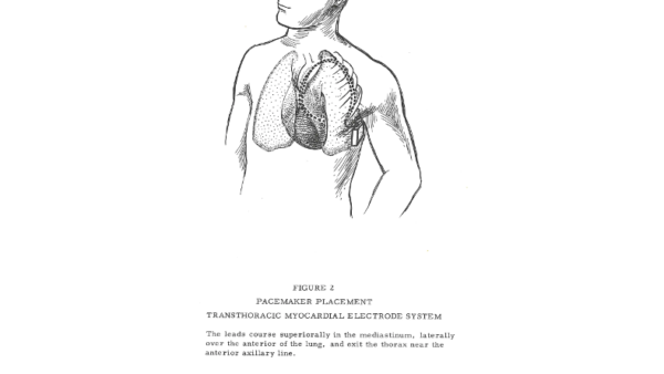 Pacemaker-Placement